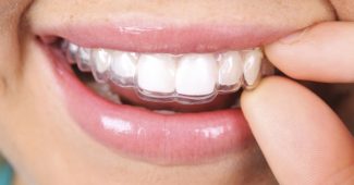 À la découverte de l&rsquo;Invisalign