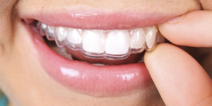 À la découverte de l&rsquo;Invisalign